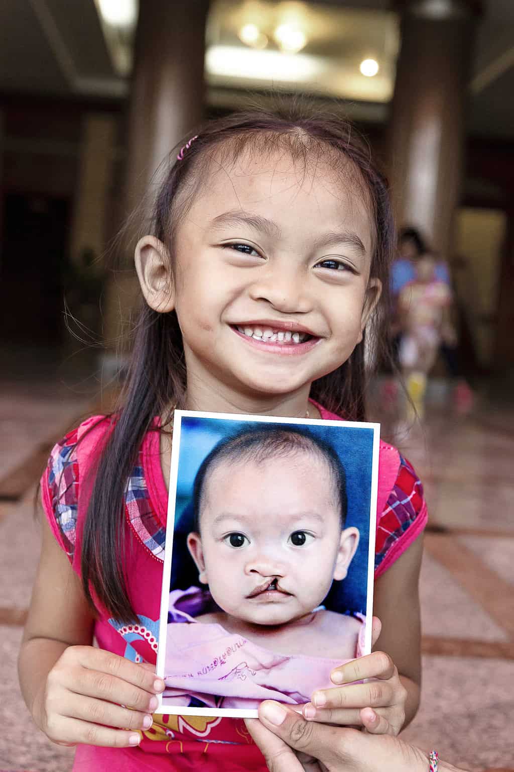 Cleft Lip And Palate Causes Symptoms And Treatments Mummy Matters