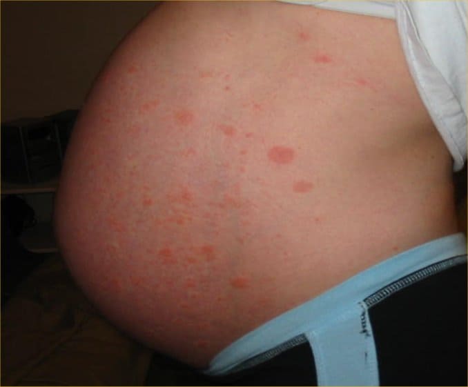 Ever Heard Of Puppp Rash In Pregnancy Mummy Matters