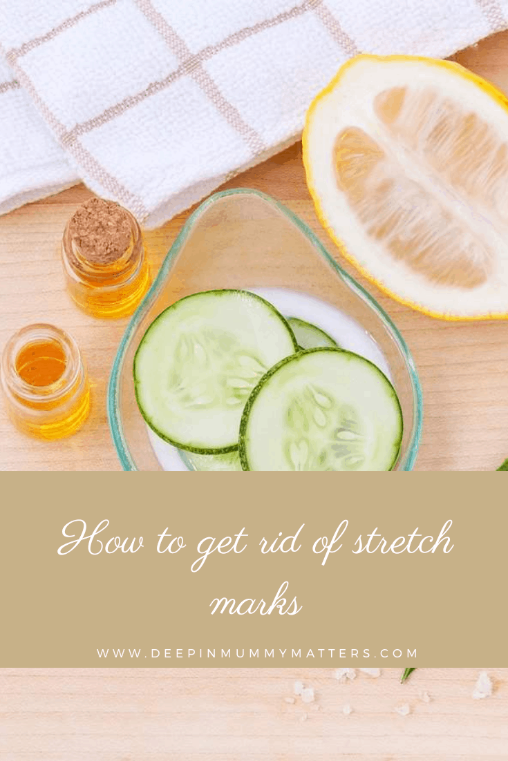 How to get rid of stretch marks