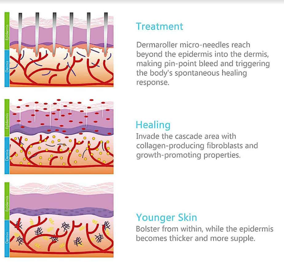 How does a Derma Roller work?