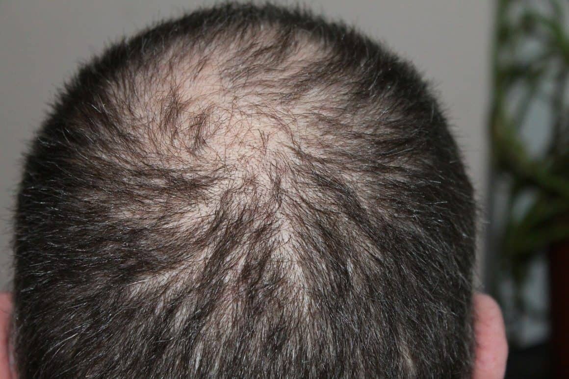 Possible Reasons Why You Are Losing Your Hair