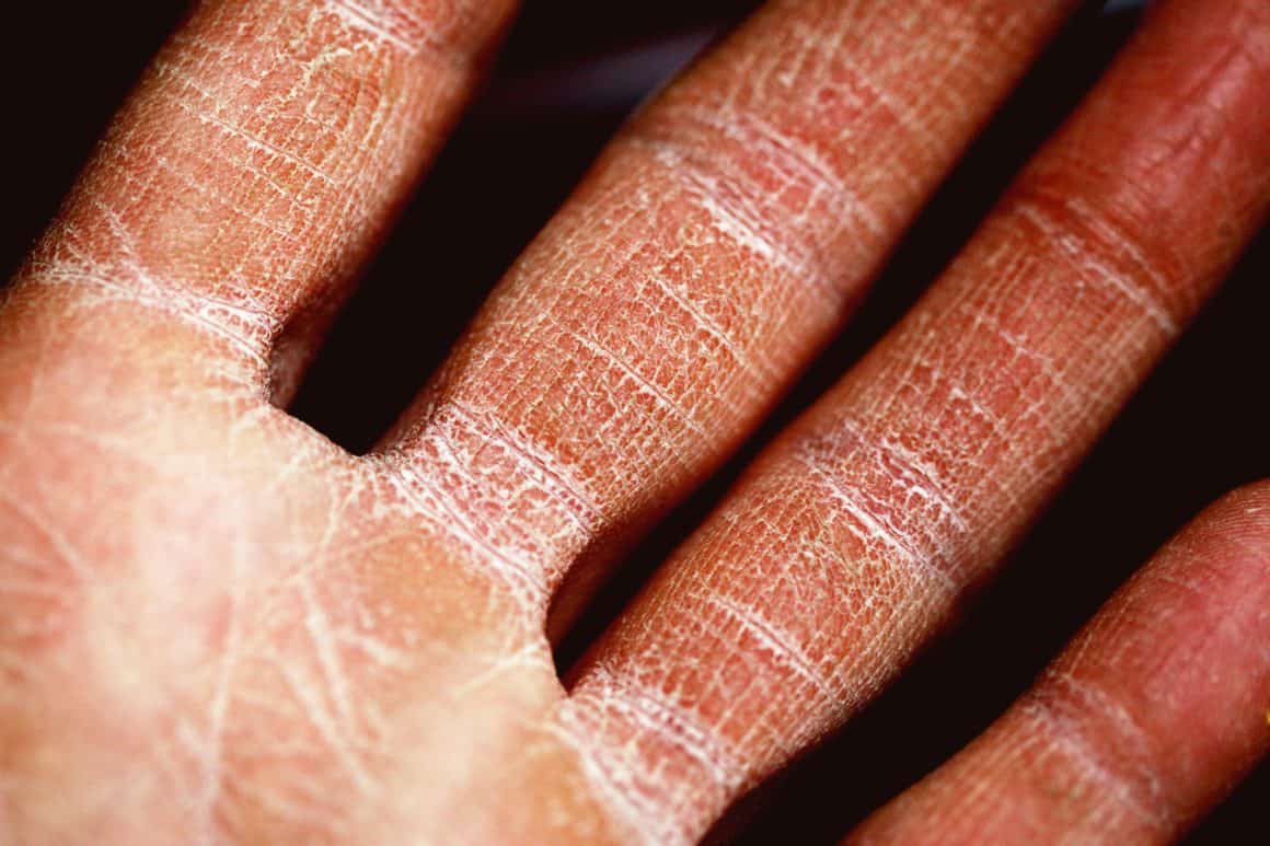 How to Treat Eczema Through Changing Your Diet