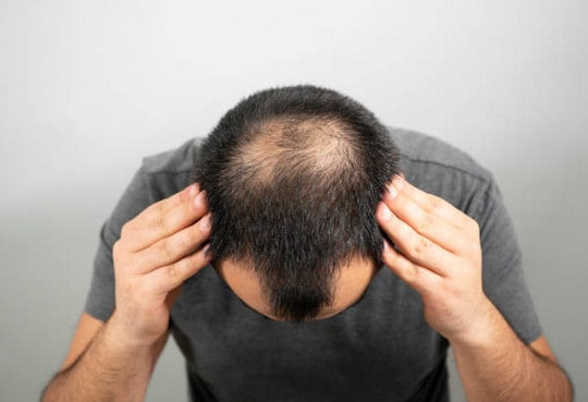 Norwood Scale: Popular Stages of Hair Loss in Men 1