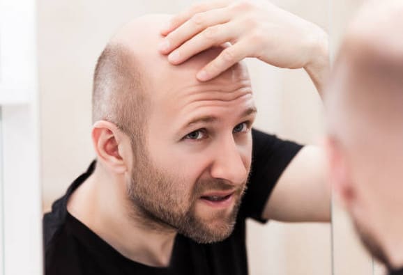 Norwood Scale: Popular Stages of Hair Loss in Men 2