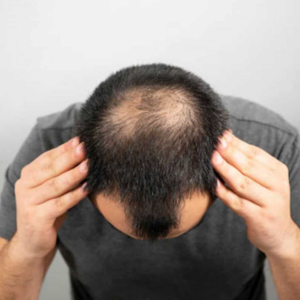 Norwood Scale: Popular Stages of Hair Loss in Men