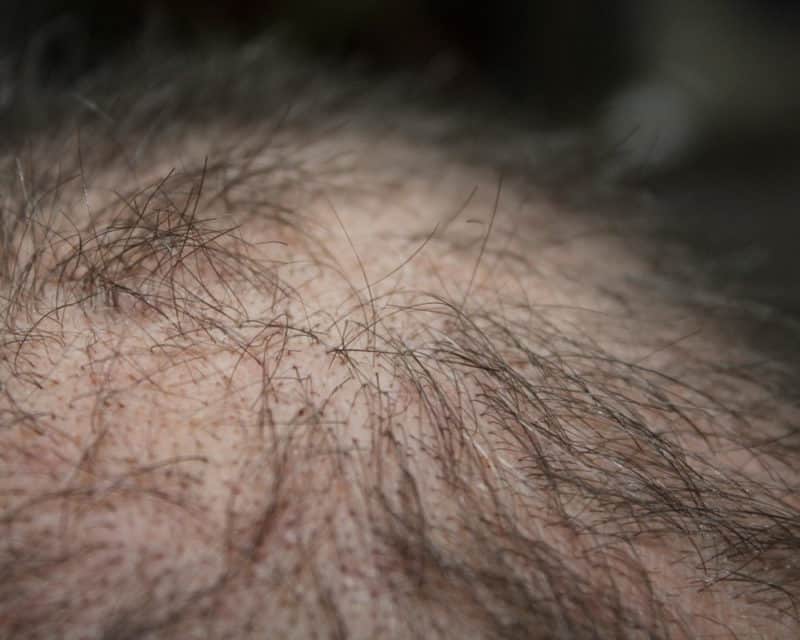 Everything You Need To Know About Foreign Hair Transplants 1