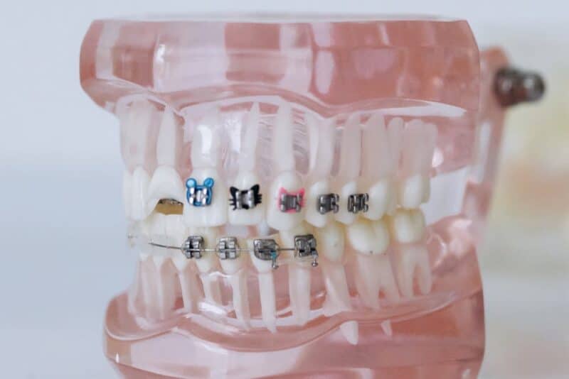 Braces