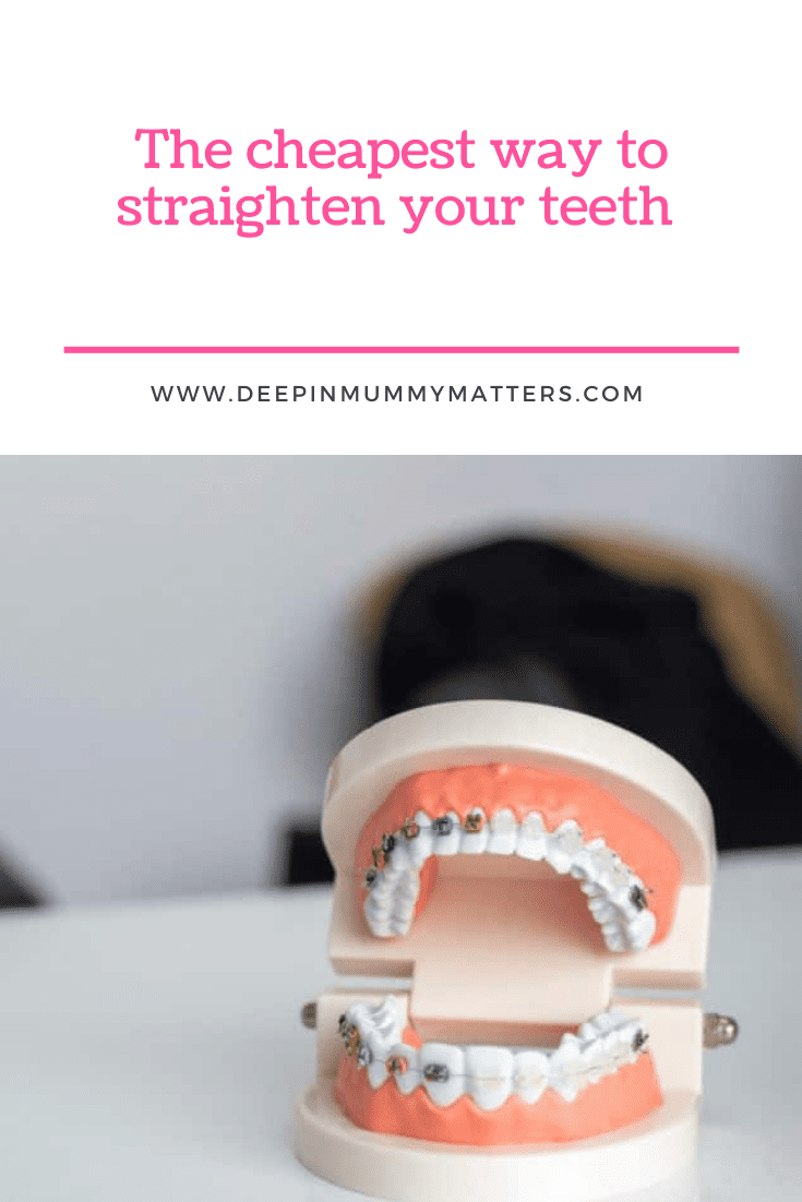 The cheapest way to straighten your teeth 1