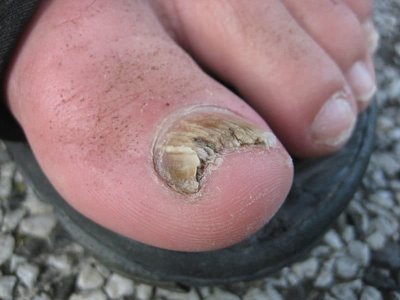 toenail fungus