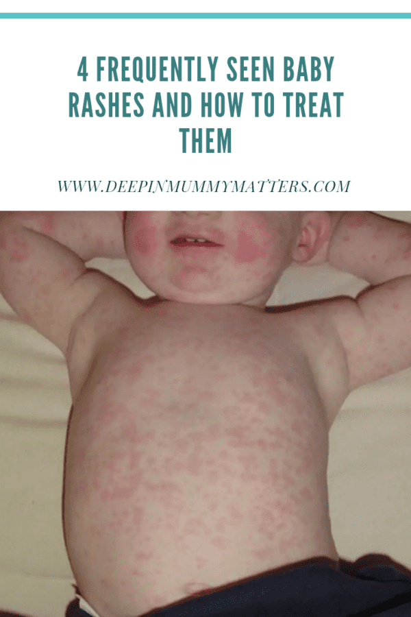 4 Frequently Seen Baby Rashes and How to Treat Them - Mummy Matters ...