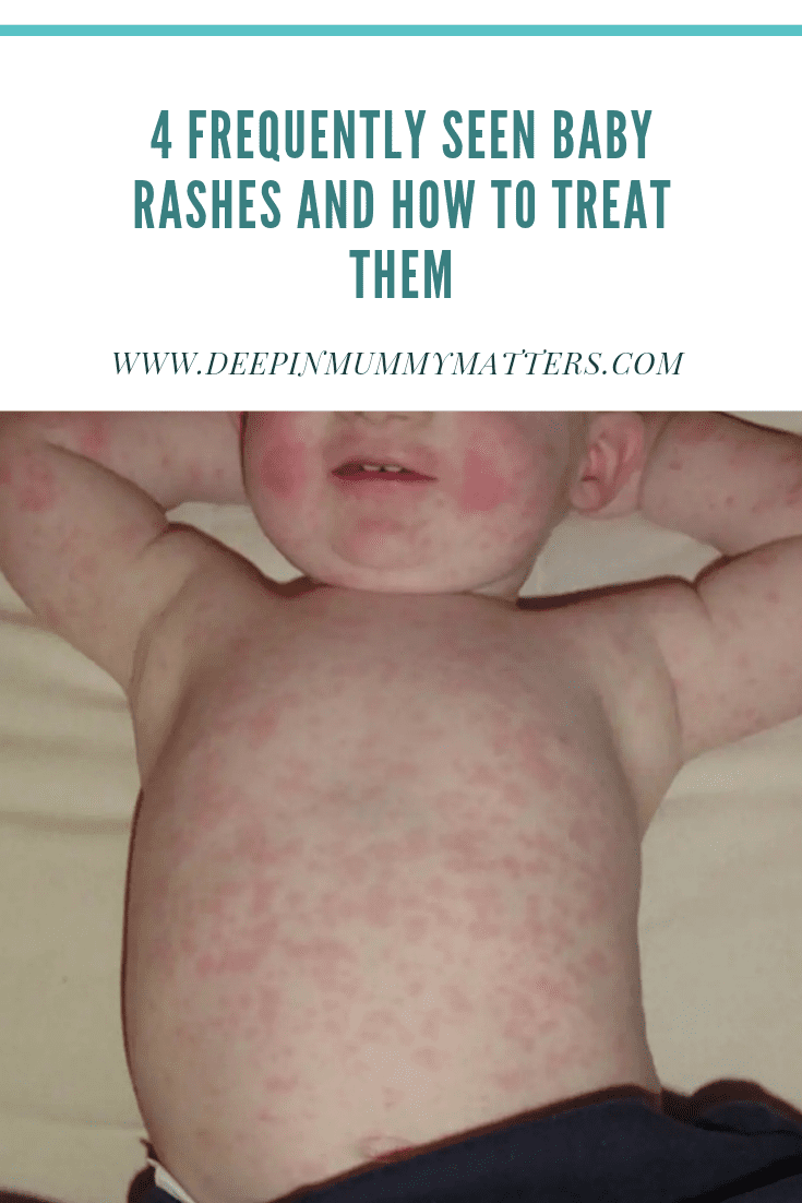 4 Frequently Seen Baby Rashes and How to Treat Them 2