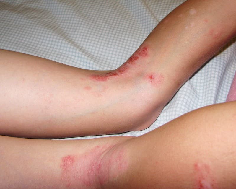 4 Frequently Seen Baby Rashes and How to Treat Them 1