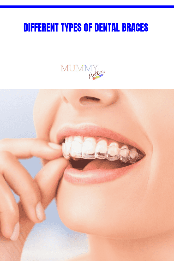 Different Types of Dental Braces - Mummy Matters: Parenting and Lifestyle