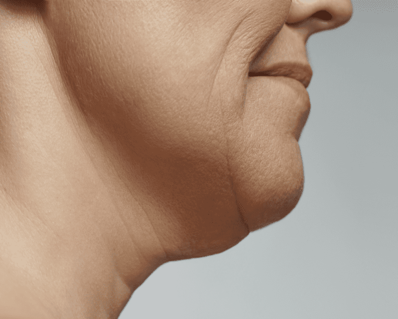 facial liposuction