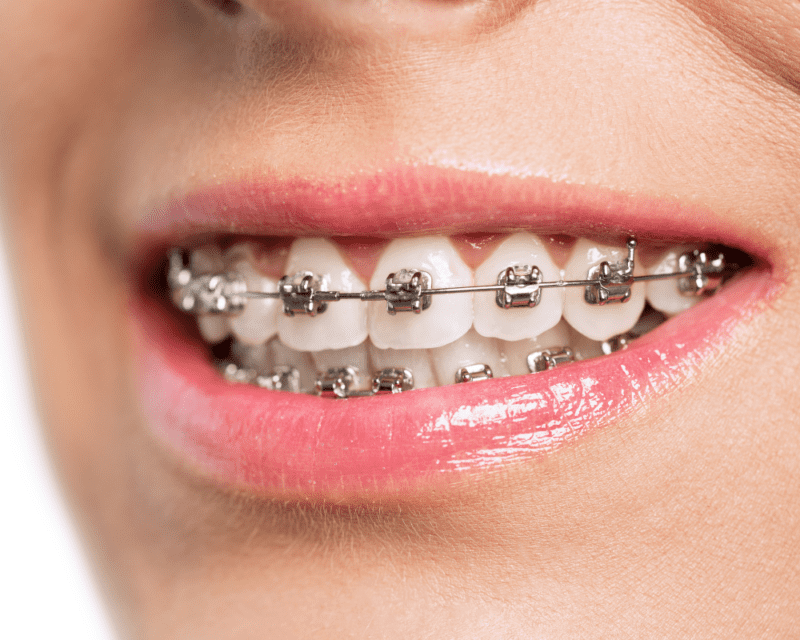 Different Types of Dental Braces 1