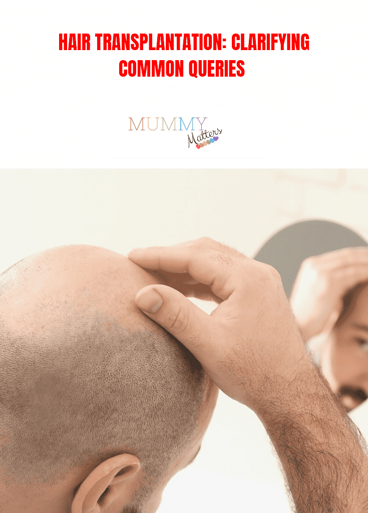 Hair Transplantation: Clarifying Common Queries 2