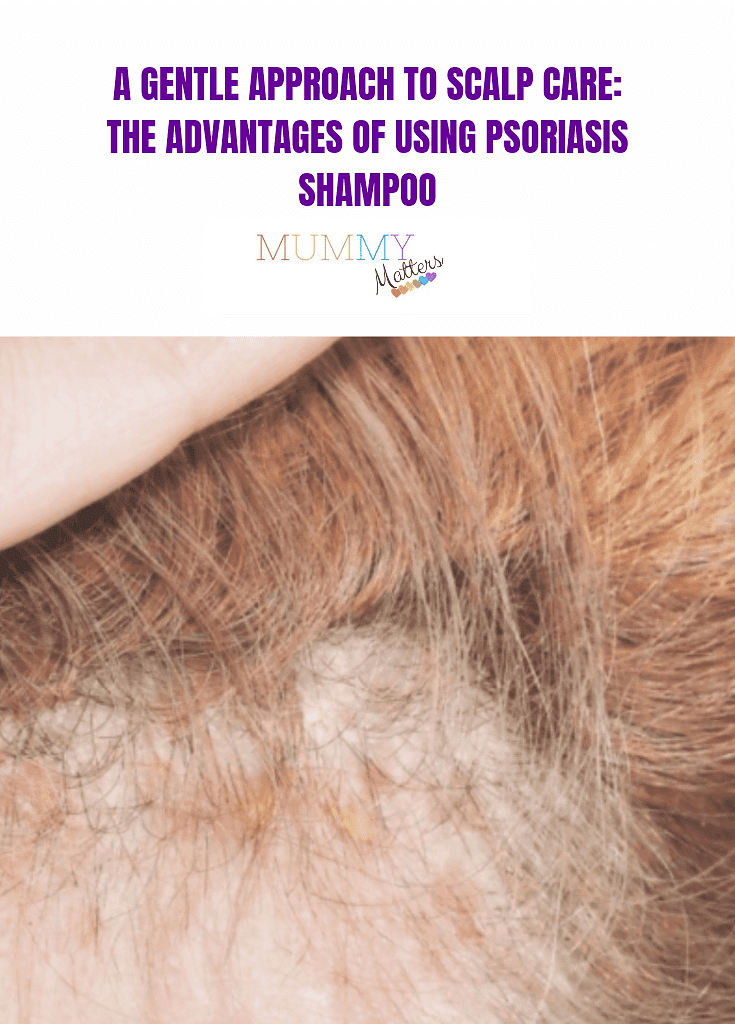 A Gentle Approach to Scalp Care: The Advantages of Using Psoriasis Shampoo  1