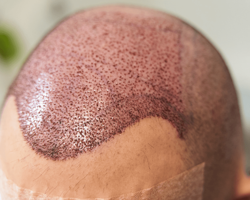 Hair Transplantation