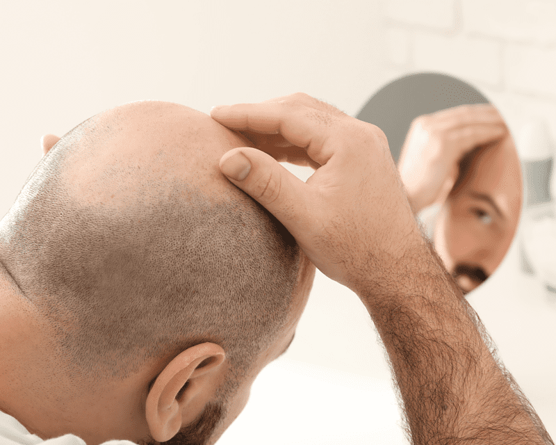 Hair Transplantation