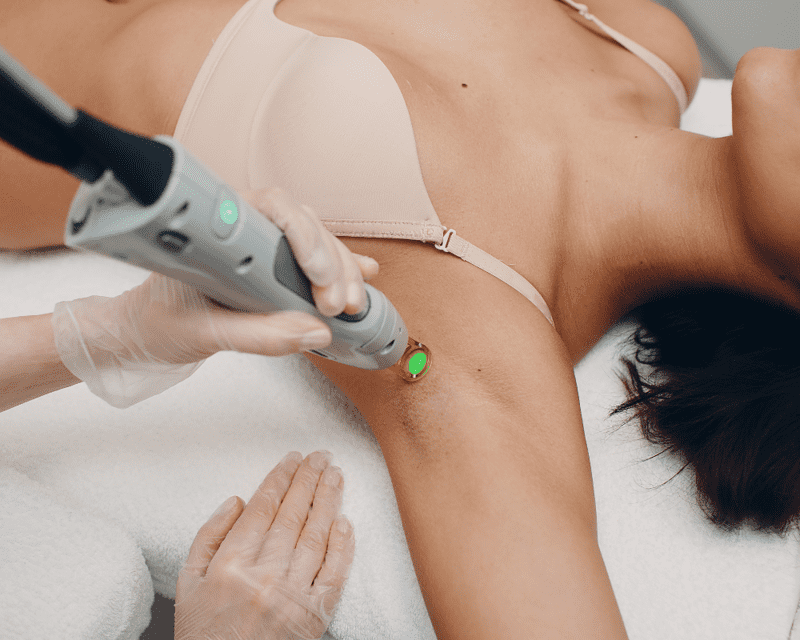 Laser Hair Removal