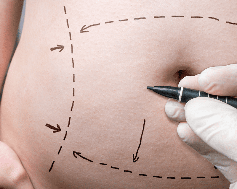 Restoring Your Body Confidence: The Benefits Of Body Contouring And Breast Lift Surgery for Mom 1
