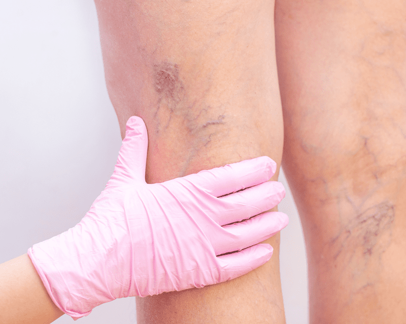 Practices That Are Beneficial To Strong And Healthy Veins