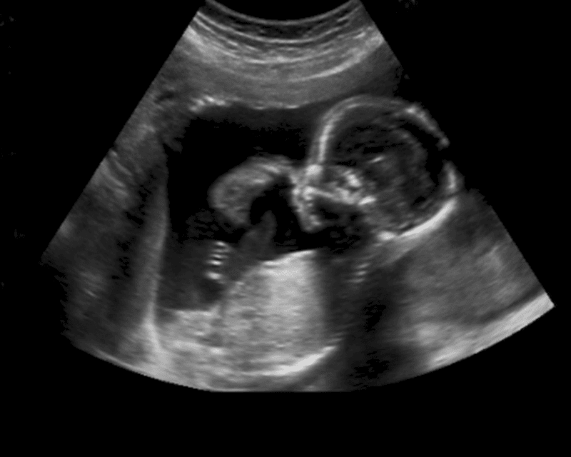 20 wk scan