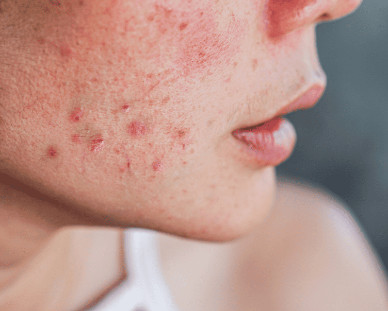 Treating Common Skin Concerns